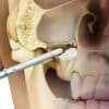Cursus sinusbodemelevaties / sinuslift | Implant College 01